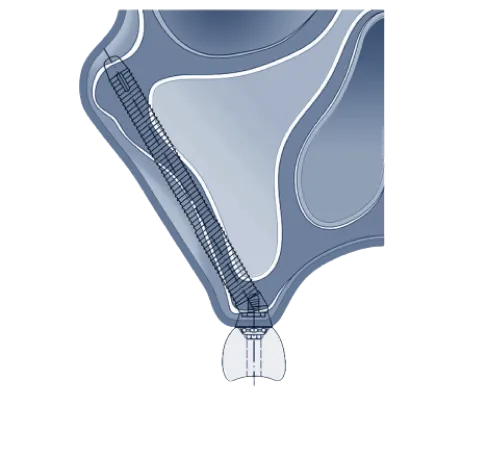 W&H Zygomatic Implant Surgery Handpiece (SZ-75) 20:1